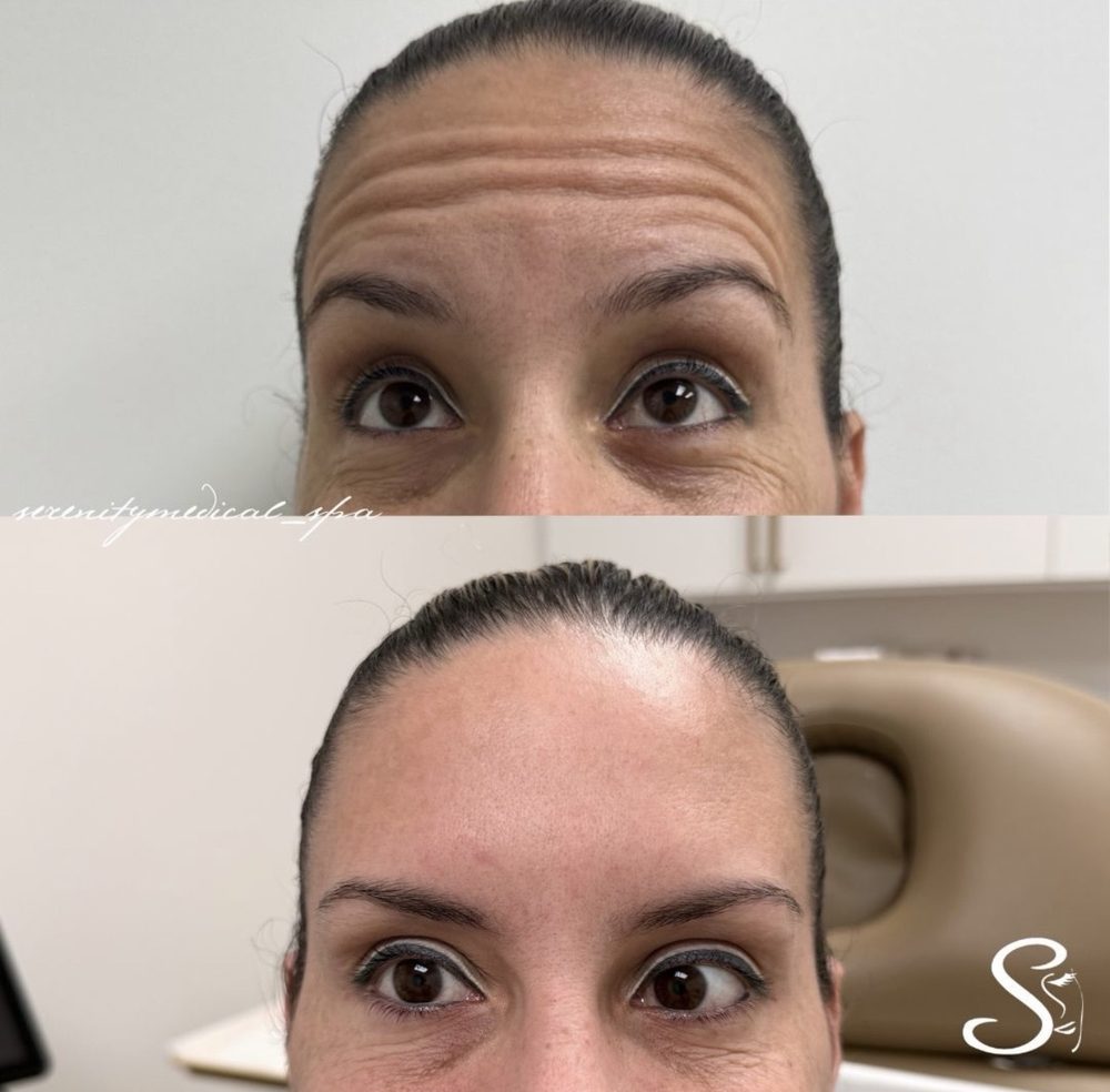 Antes y después Botox frente Serenity Medical Spa