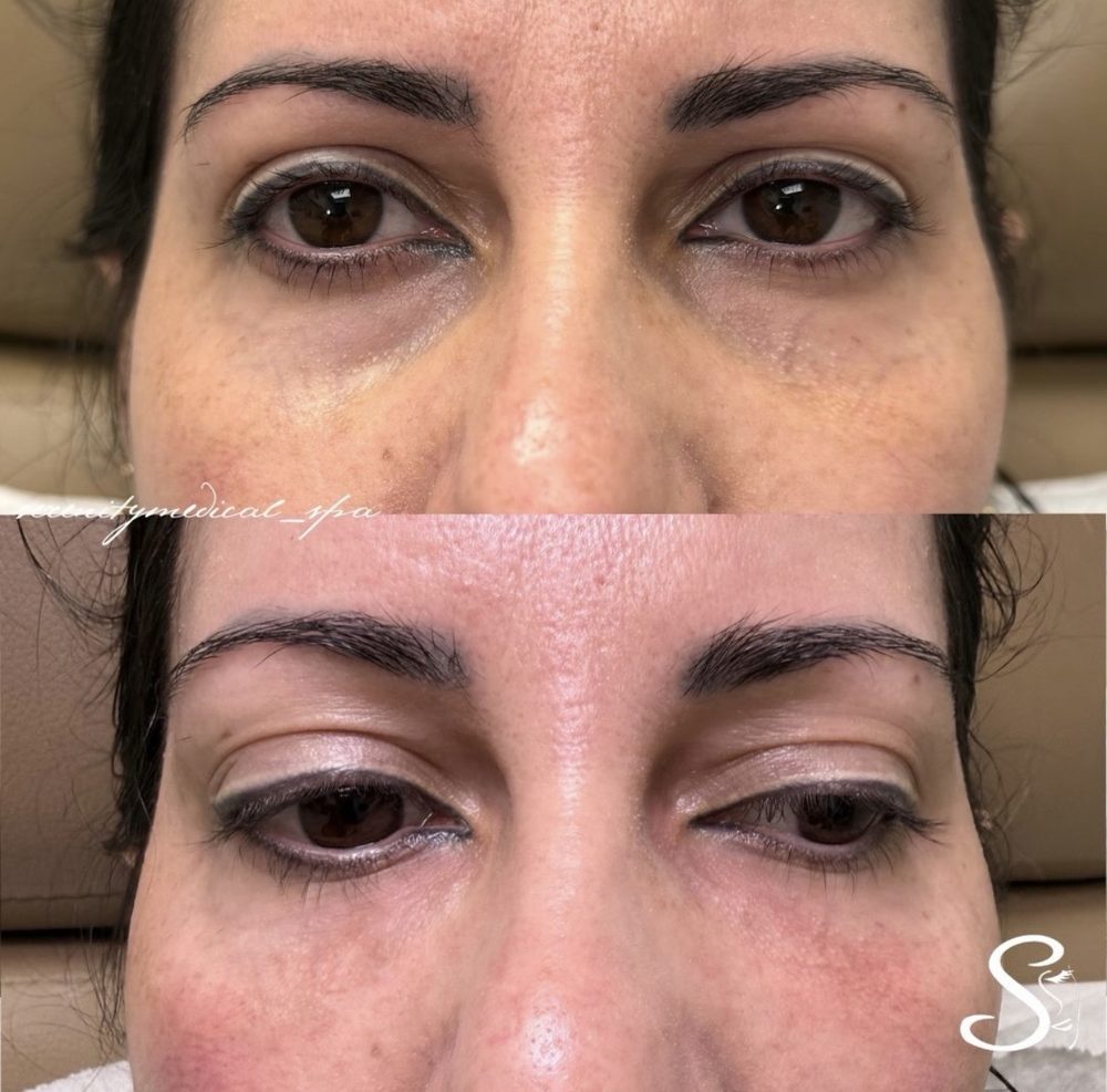 Antes y después Under Eyes Filler Serenity Medical Spa