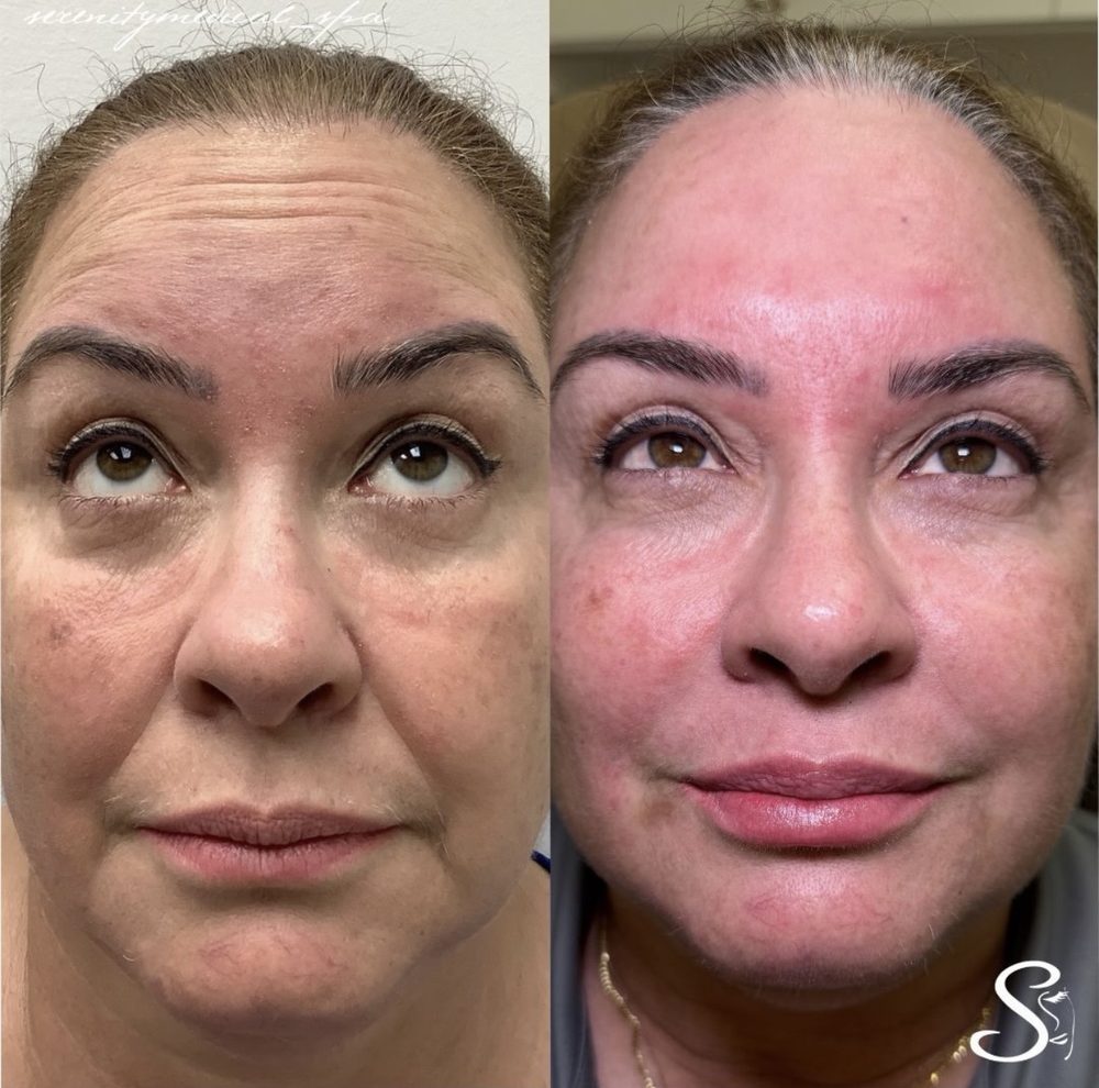 Antes y después Armonización Facial Serenity Medical Spa
