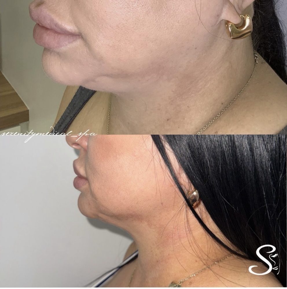 Antes y después Endolift Serenity Medical Spa