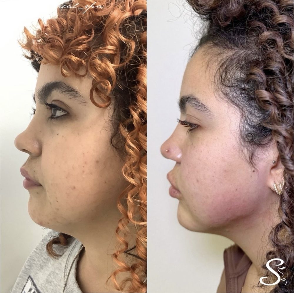 Antes y después Endolift Serenity Medical Spa
