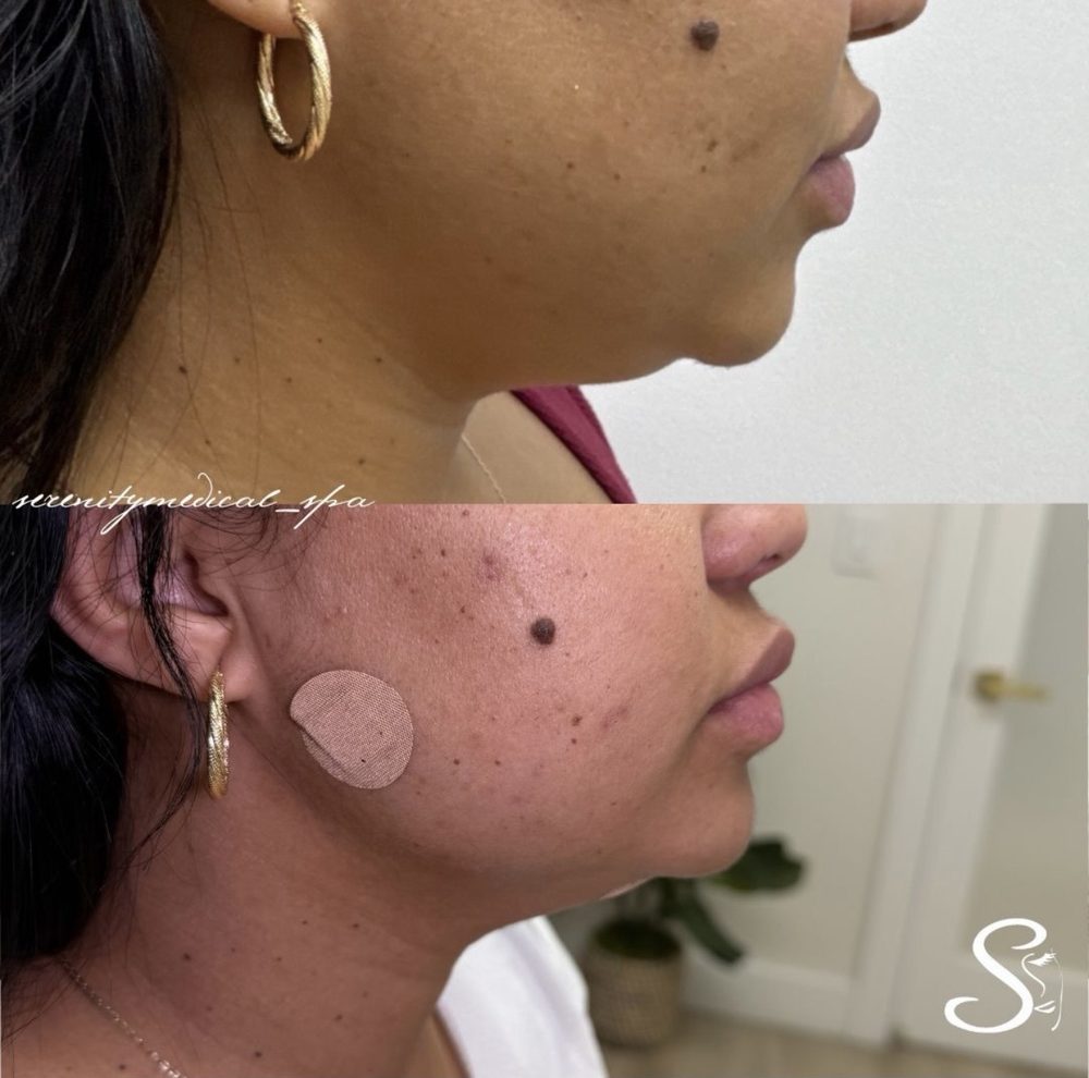 Antes y después Endolift Serenity Medical Spa