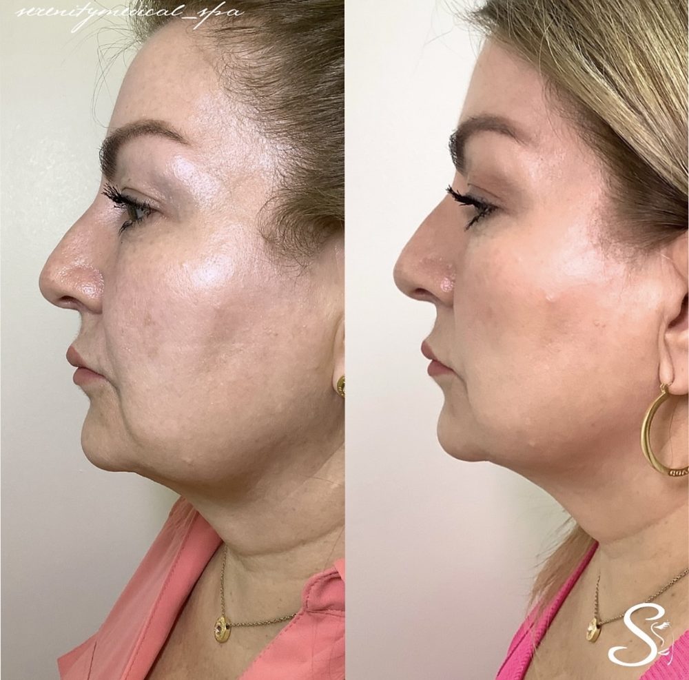 Antes y después Endolift Serenity Medical Spa
