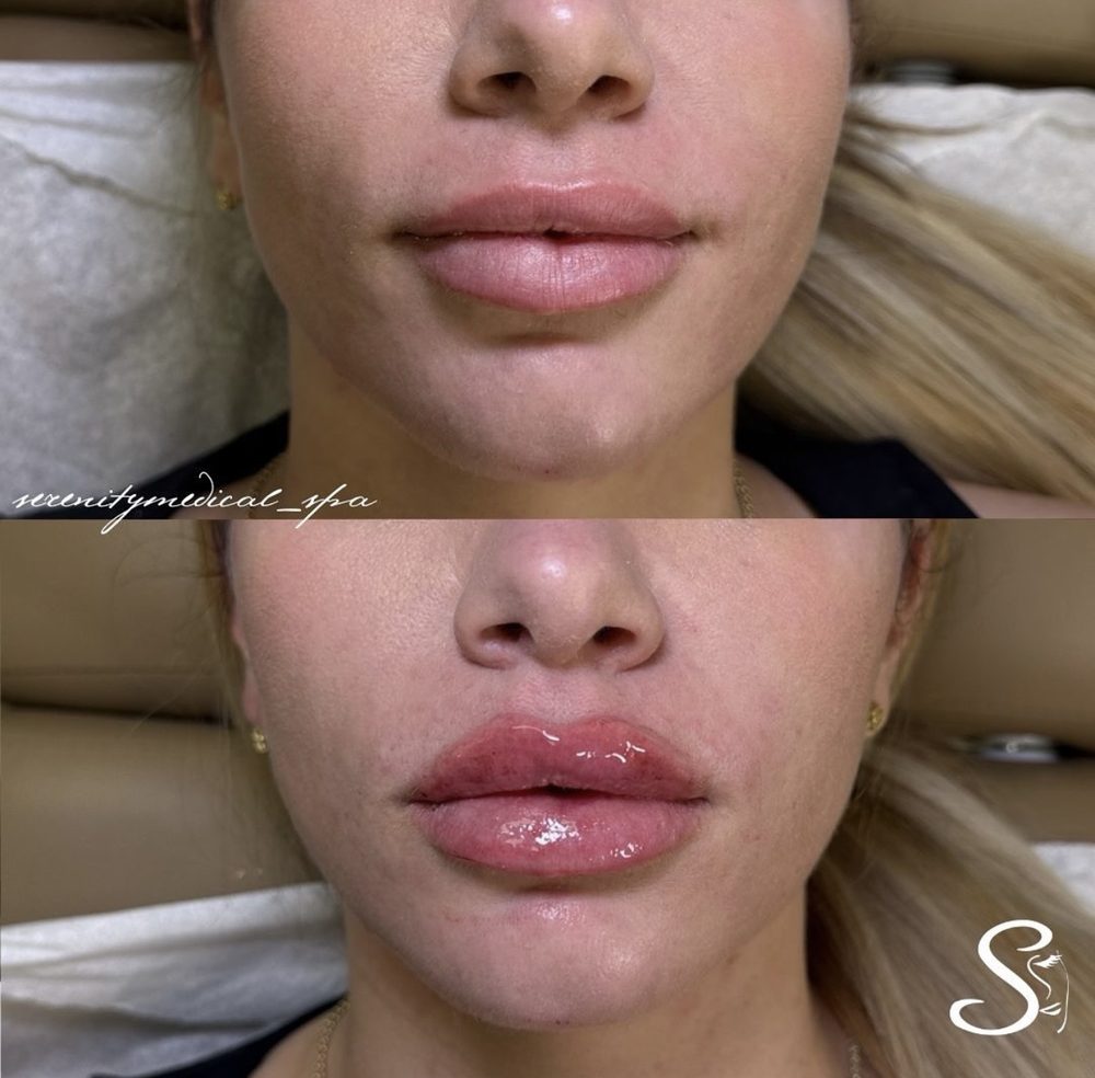 Antes y después Lip Filler Serenity Medical Spa